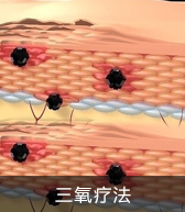 黑色素種植療法