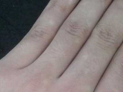 孕婦白癜風(fēng)病會(huì)遺傳嗎？