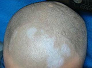 頭部白癜風(fēng)病發(fā)有哪些癥狀呢？