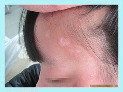 頭部白癜風(fēng)