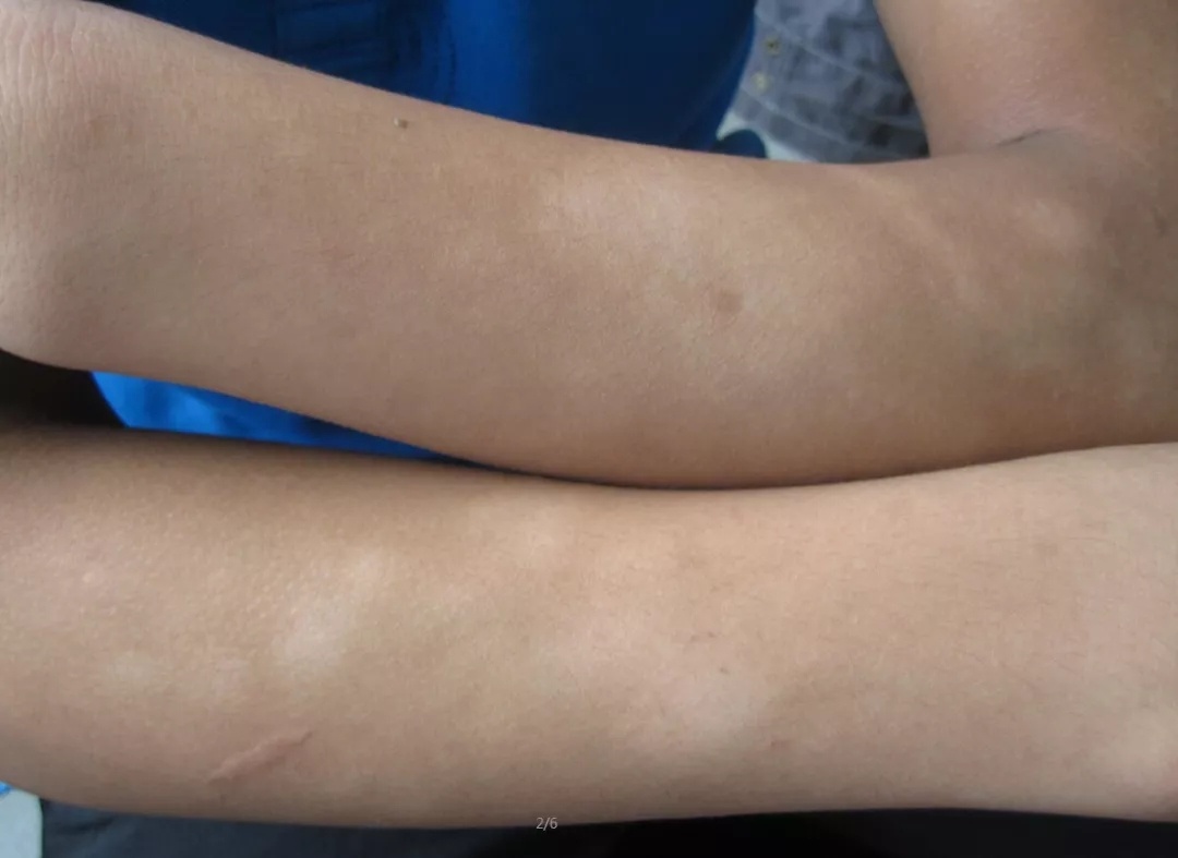 白斑的形狀數(shù)目