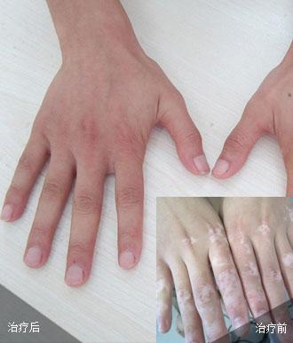 白癜風(fēng)初期診療患者壓力小易恢復(fù)