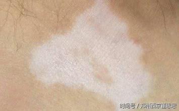白癜風(fēng)的白斑顏色有哪些？