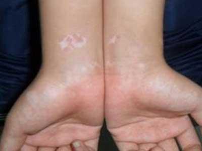 初期白癜風(fēng)