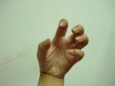 黑色素種植后注意