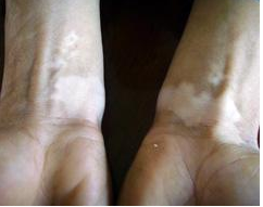 雙臂白癜風(fēng)患者如何護(hù)理