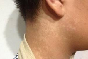 局限型白癜風(fēng)怎么治