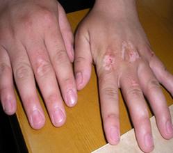 肢端型白癜風(fēng)會不會傳染給其他人