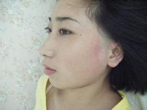 老年毛囊型白癜風有哪些危害?