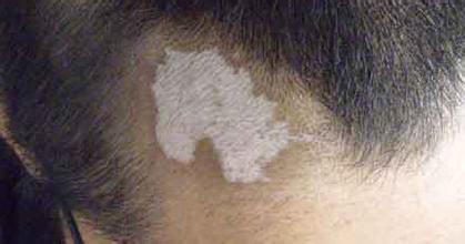 要想診療好毛囊型白癜風(fēng)