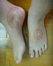 肢端型白癜風(fēng)的科學(xué)診斷方法有哪些