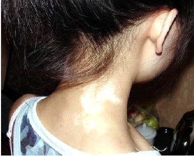 頸部白癜風(fēng)診療的要點在哪?