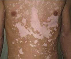 散發(fā)型白癜風(fēng)想要診療好應(yīng)該要做到哪些事情