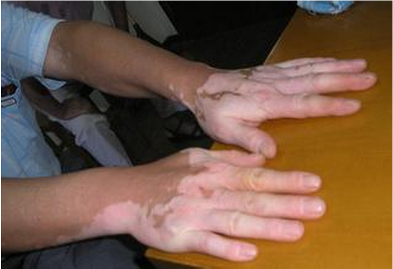 手上的白斑能夠去除掉嗎?