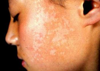 臉上的白斑在診療的時候應(yīng)該注意哪些問題?