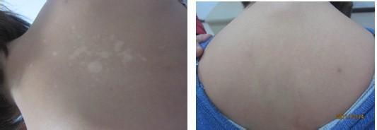 局限型白癜風(fēng)出現(xiàn)是因為什么?