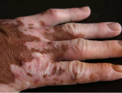 手部白癜風該怎么去預(yù)防復(fù)發(fā)呢?