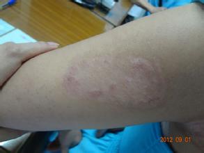 手臂白癜風(fēng)患者要忌食哪些食物?