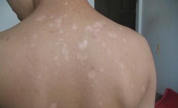 夏季要怎么預(yù)防背部白癜風(fēng)呢?