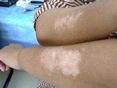 手臂出現(xiàn)白癜風是因為什么原因?