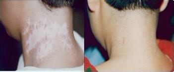 頸部如果出現(xiàn)了白癜風(fēng)應(yīng)該怎么辦呢?