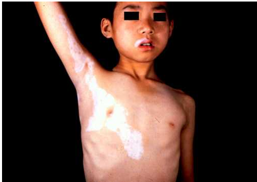 節(jié)段型白癜風(fēng)有哪些可行的預(yù)防的措施?