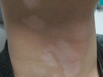 頸部白癜風危害有哪些