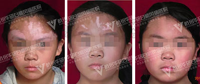 下城區(qū)華研白癜風(fēng)醫(yī)院好不好？