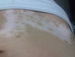 如何防止散發(fā)型白癜風繼續(xù)發(fā)展呢