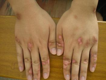 肢端型白癜風的預防有什么方法