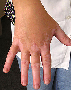 手部白癜風(fēng)患者能不能涂指甲油?